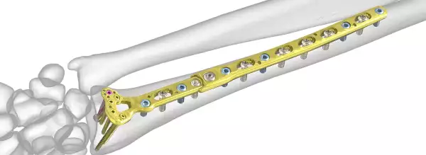 титановая пластина при переломах в Киеве