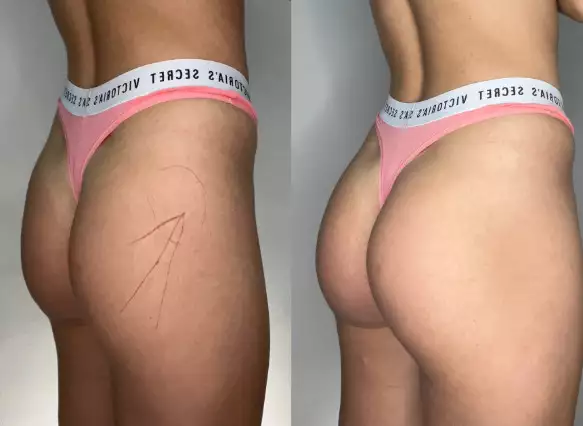 Увеличение ягодиц в клинике Алтеро