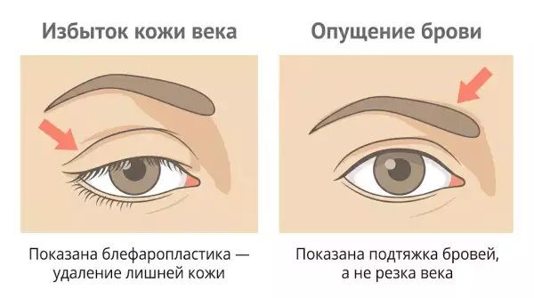 Сравнение птоза верхнего века и опущения бровей — когда нужна блефаропластика а когда подтяжка лба