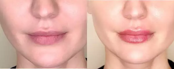 Увеличение губ